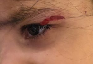 ocular trauma eye
